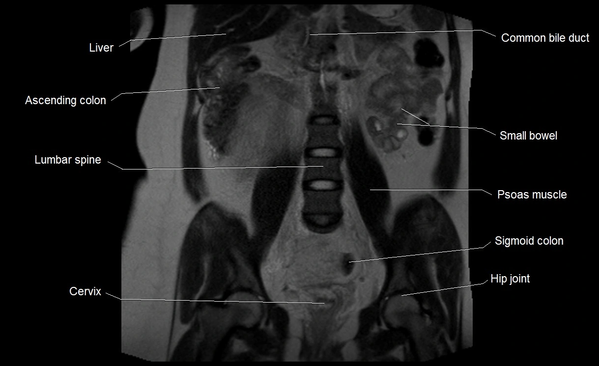 MRI Anatomy of pregnancy image 21.webp